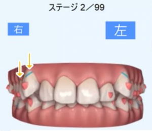 インビザライン画像