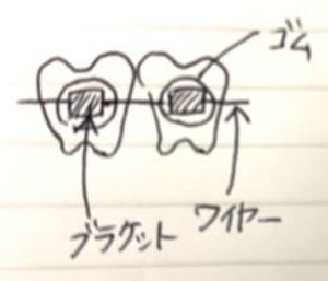 ブラケットの説明図